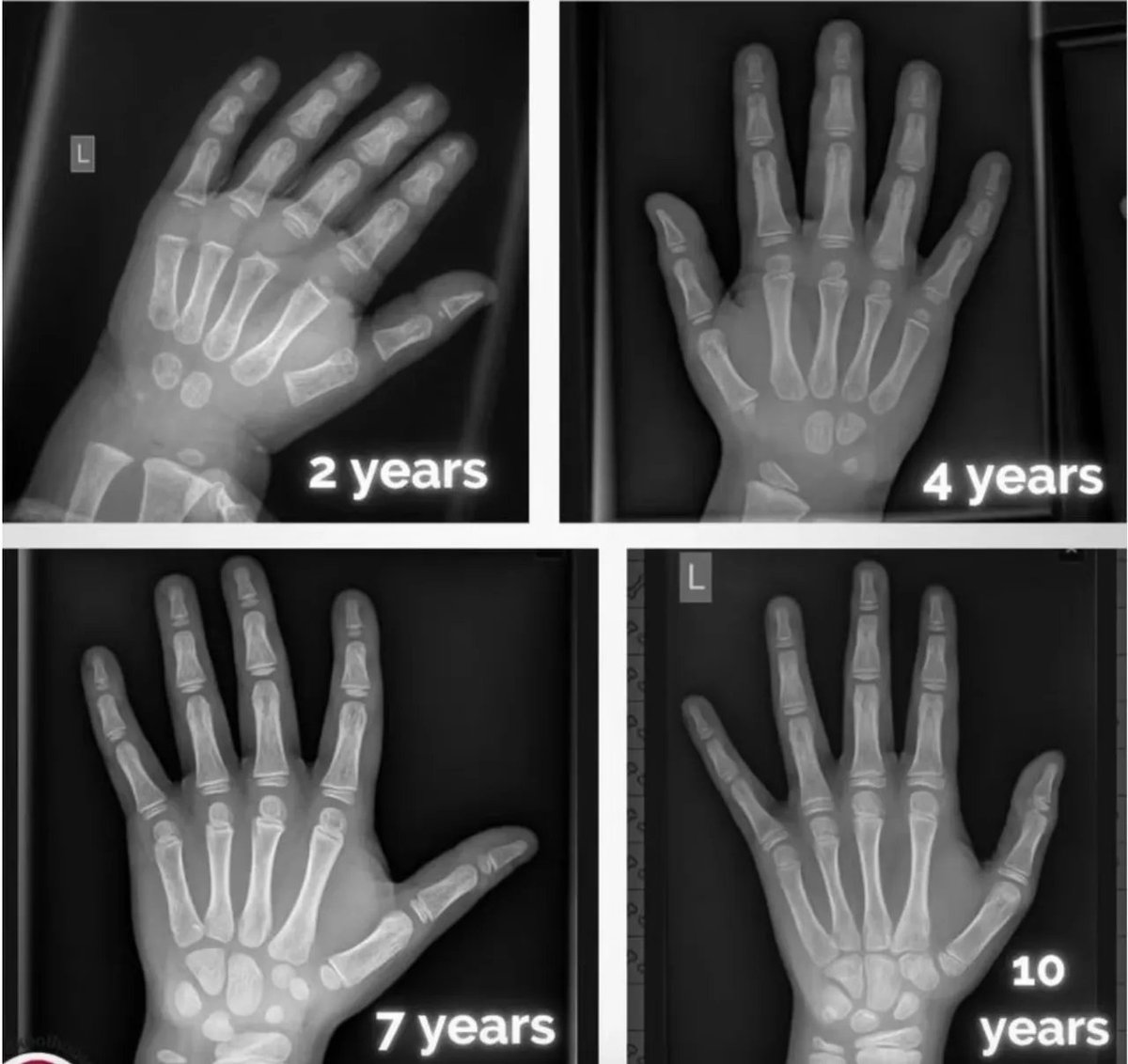 Hand xray